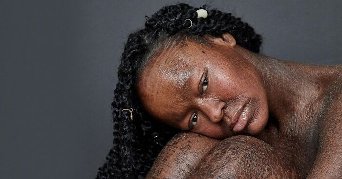 Woman Who Sheds Skin Every Two Weeks Becomes Probably The First Model Who Has This Condition