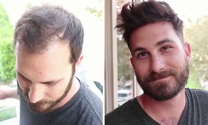 Before-After-Hair-Replacement-Phildoeshair