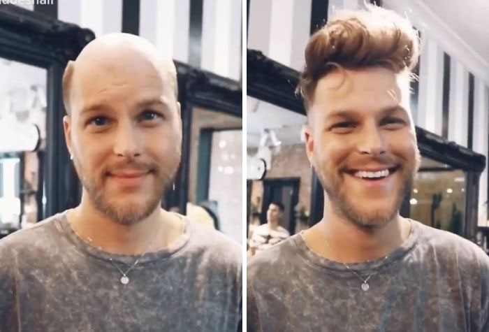 Before-After-Hair-Replacement-Phildoeshair