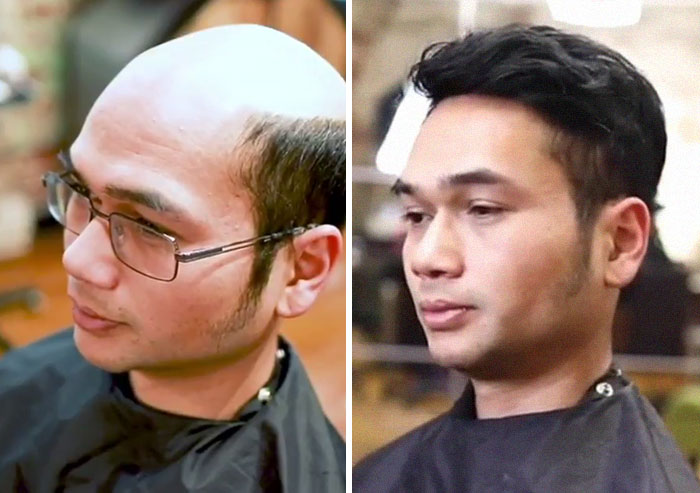 Before-After-Hair-Replacement-Phildoeshair