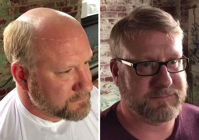 Before-After-Hair-Replacement-Phildoeshair