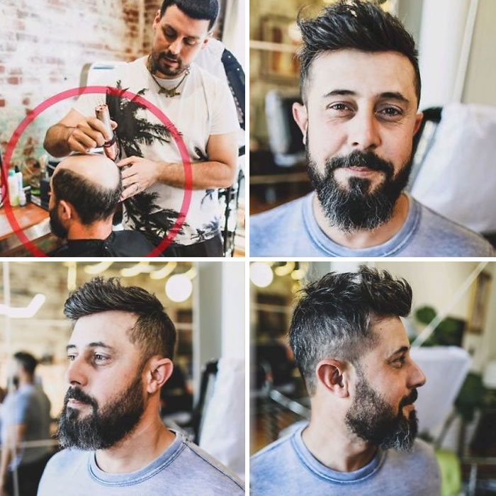 Before-After-Hair-Replacement-Phildoeshair