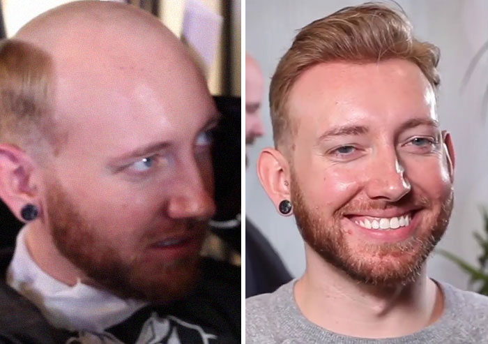 Before-After-Hair-Replacement-Phildoeshair