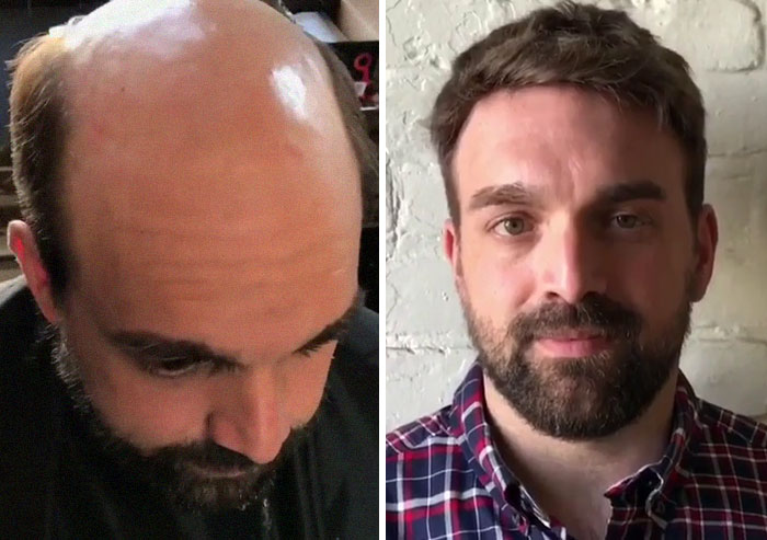 Before-After-Hair-Replacement-Phildoeshair