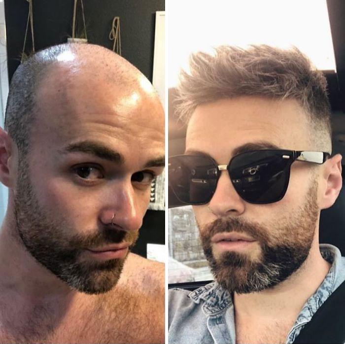 Before-After-Hair-Replacement-Phildoeshair