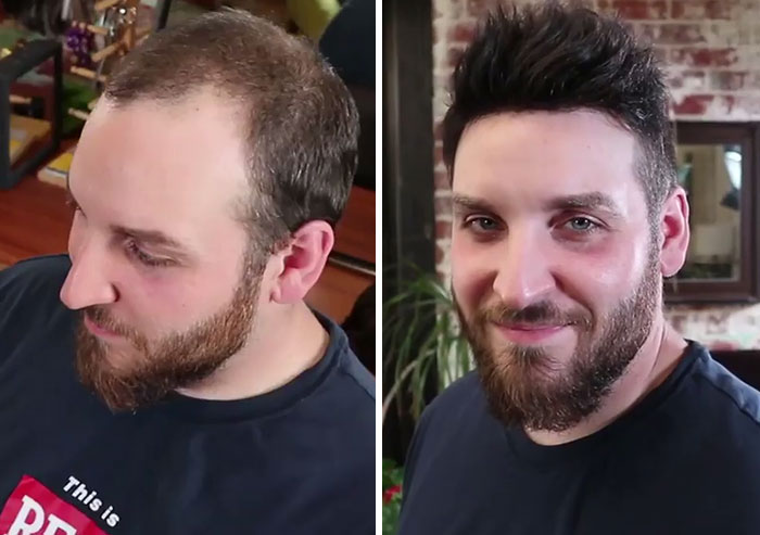 Before-After-Hair-Replacement-Phildoeshair