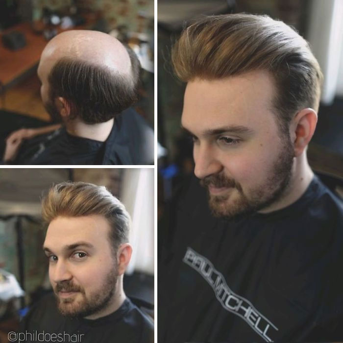 Before-After-Hair-Replacement-Phildoeshair