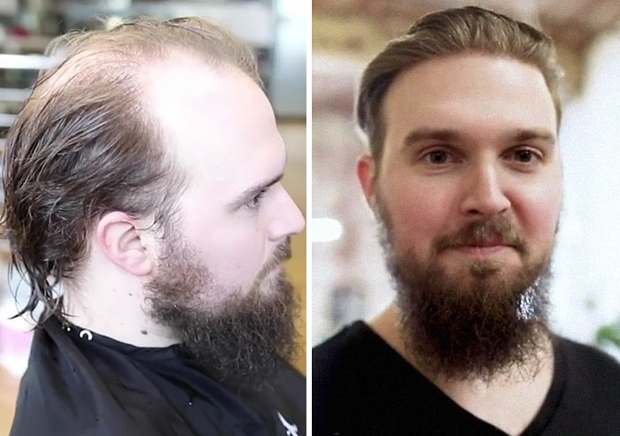 Before-After-Hair-Replacement-Phildoeshair