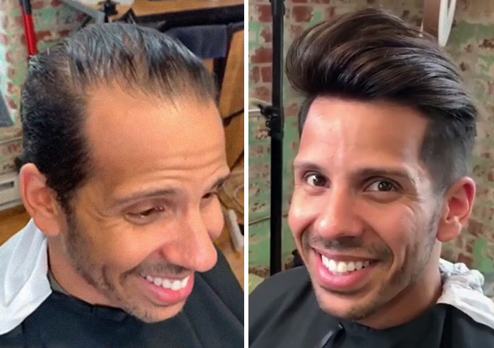 Before-After-Hair-Replacement-Phildoeshair