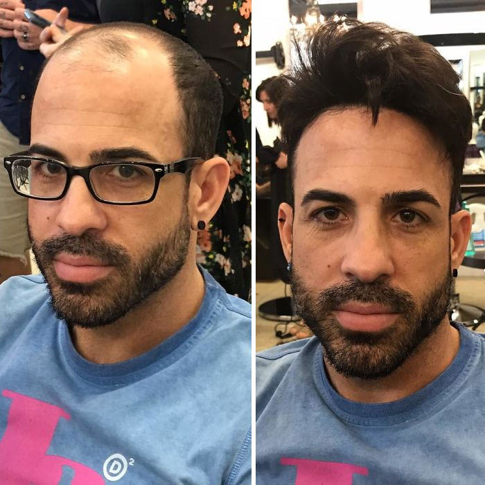 Before-After-Hair-Replacement-Phildoeshair