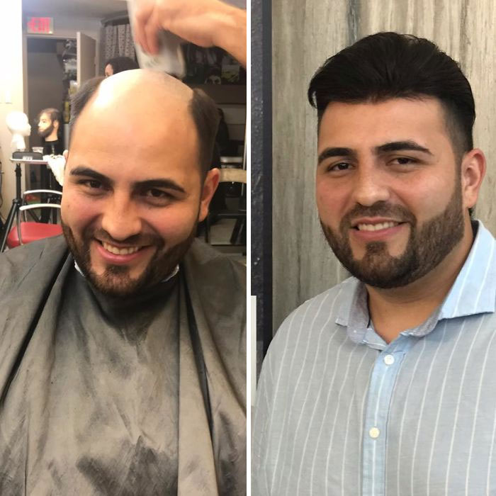 Before-After-Hair-Replacement-Phildoeshair