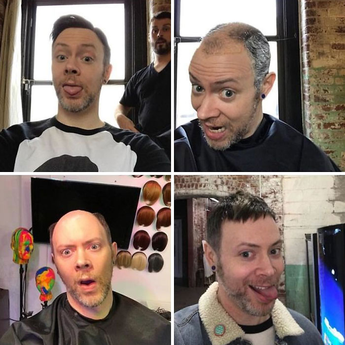 Before-After-Hair-Replacement-Phildoeshair