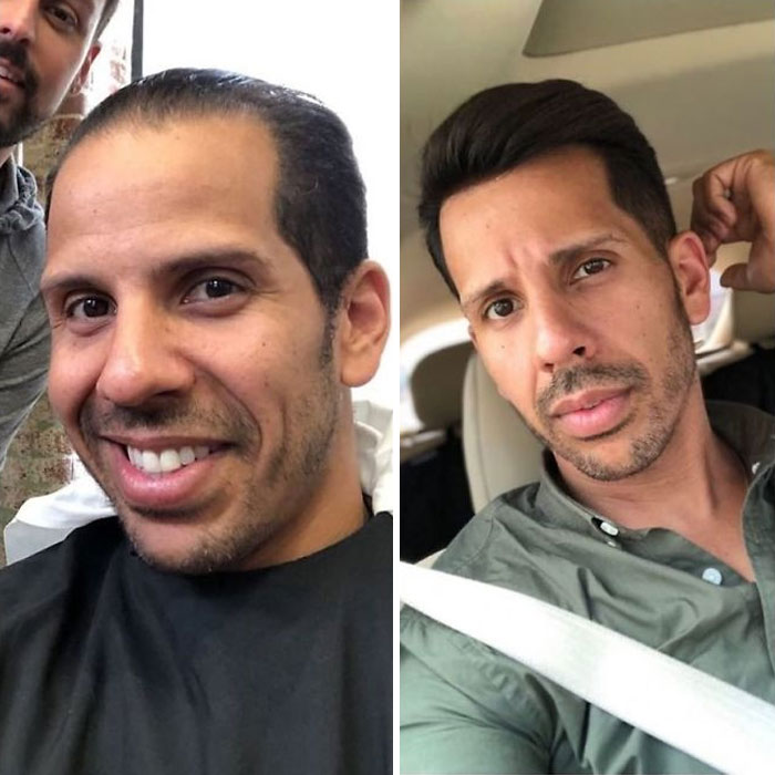 Before-After-Hair-Replacement-Phildoeshair