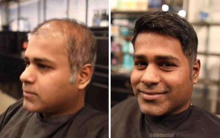 Before-After-Hair-Replacement-Phildoeshair