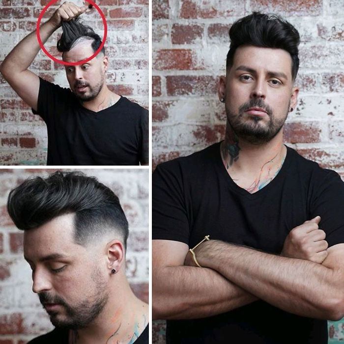 Before-After-Hair-Replacement-Phildoeshair
