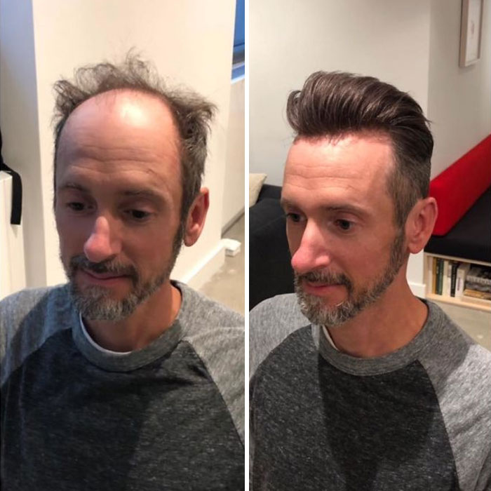 Before-After-Hair-Replacement-Phildoeshair