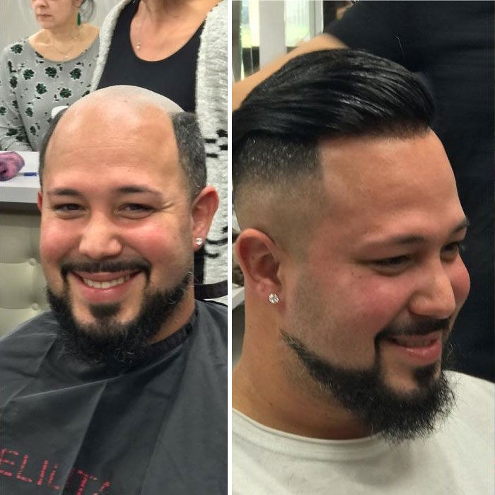 Before-After-Hair-Replacement-Phildoeshair