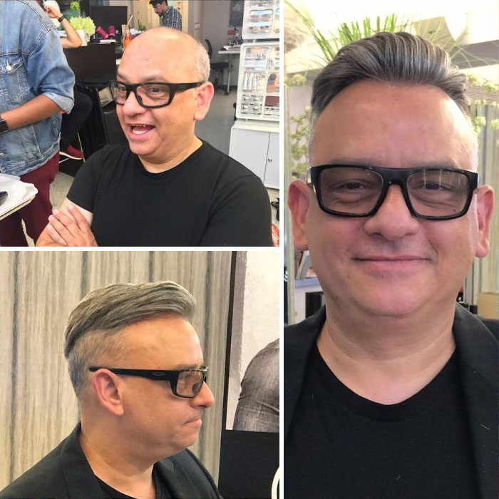 Before-After-Hair-Replacement-Phildoeshair