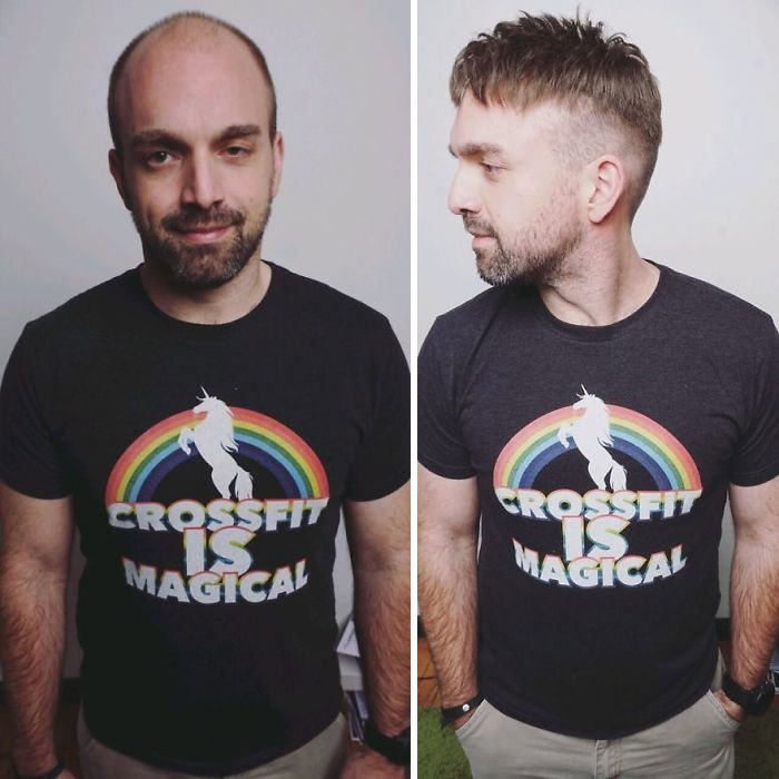 Before-After-Hair-Replacement-Phildoeshair