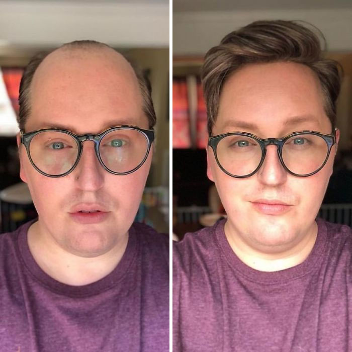 Before-After-Hair-Replacement-Phildoeshair
