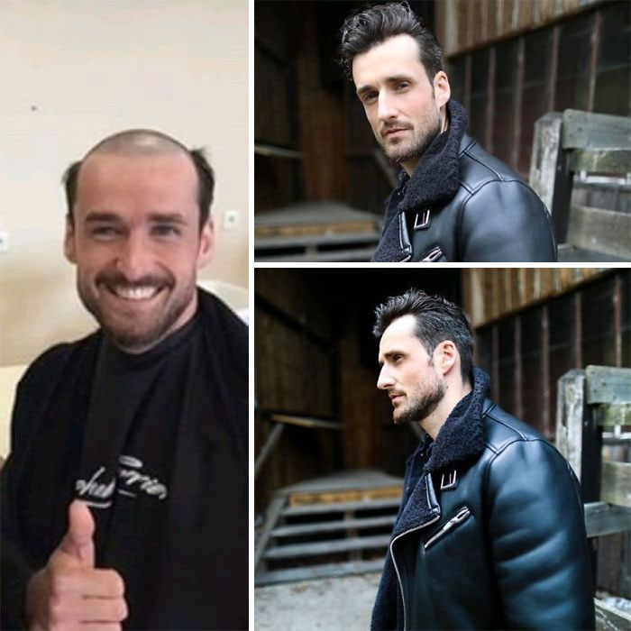 Before-After-Hair-Replacement-Phildoeshair