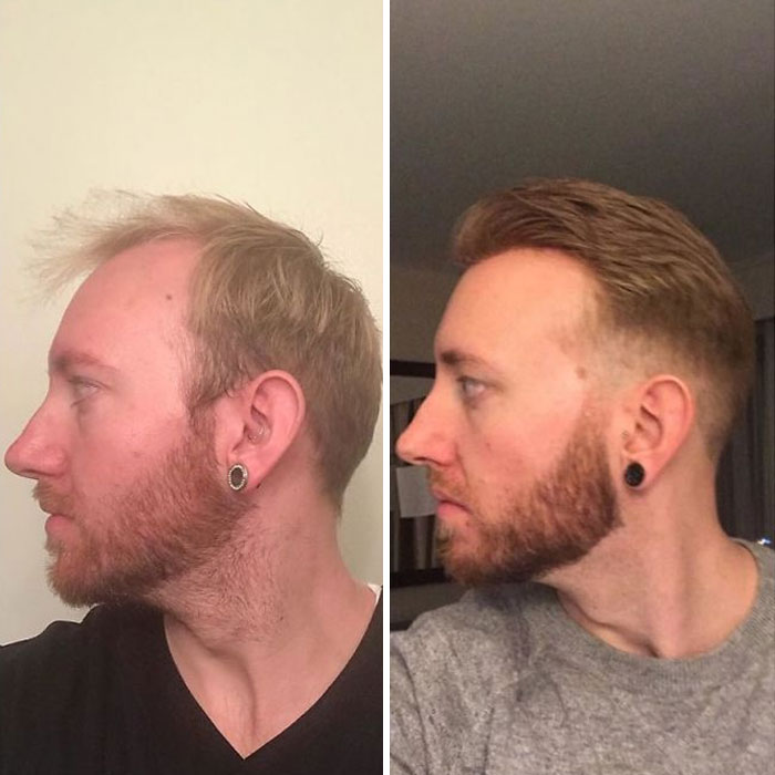 Before-After-Hair-Replacement-Phildoeshair