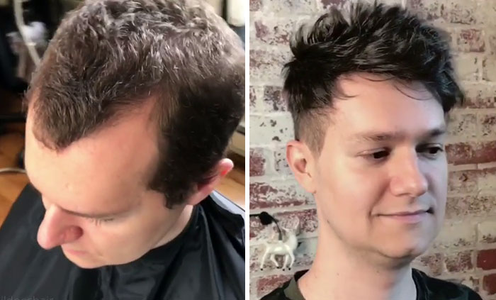 Before-After-Hair-Replacement-Phildoeshair