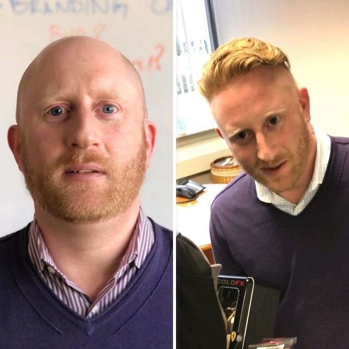 Before-After-Hair-Replacement-Phildoeshair