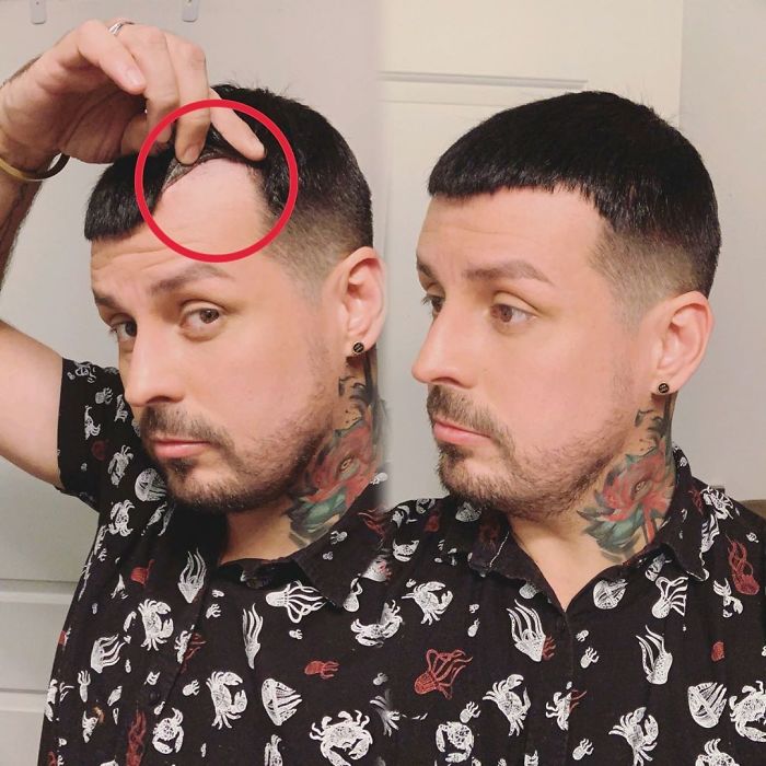 Before-After-Hair-Replacement-Phildoeshair