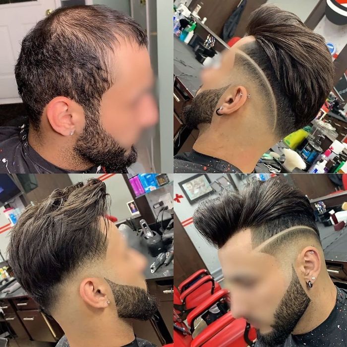 Before-After-Hair-Replacement-Phildoeshair