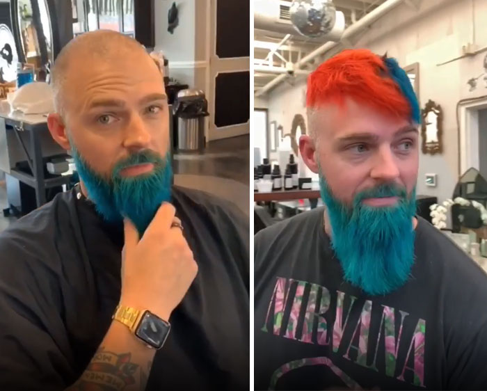 Before-After-Hair-Replacement-Phildoeshair