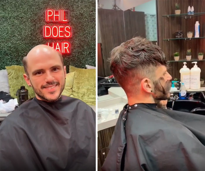 Before-After-Hair-Replacement-Phildoeshair