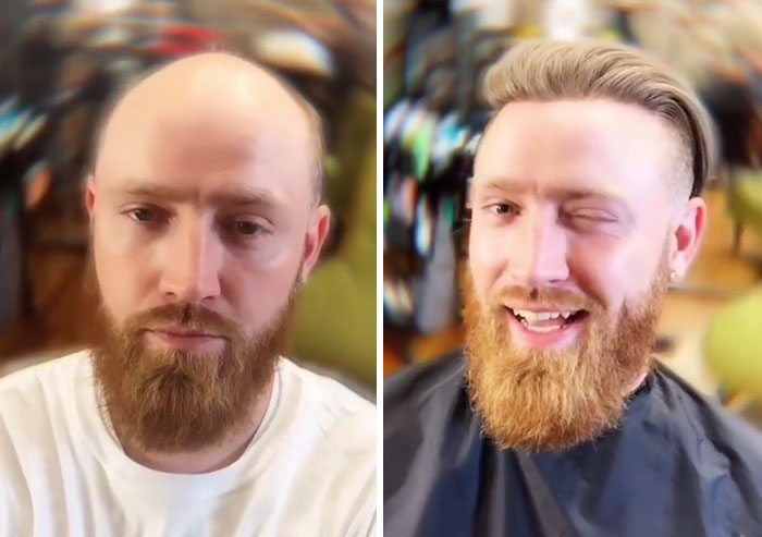 Before-After-Hair-Replacement-Phildoeshair
