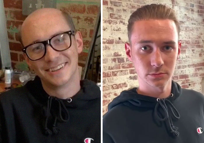 Before-After-Hair-Replacement-Phildoeshair