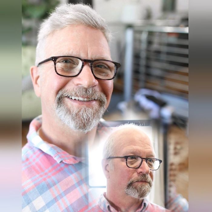 Before-After-Hair-Replacement-Phildoeshair