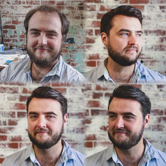 Before-After-Hair-Replacement-Phildoeshair