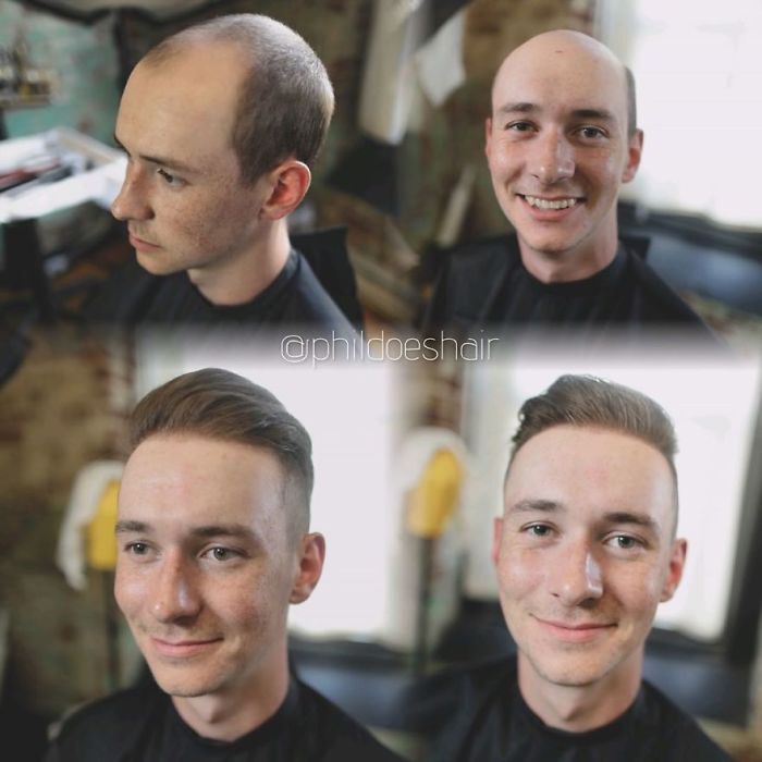 Before-After-Hair-Replacement-Phildoeshair