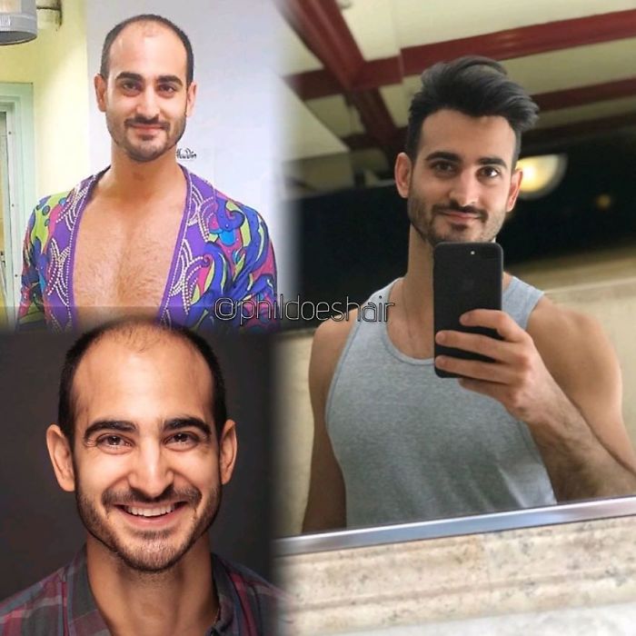 Before-After-Hair-Replacement-Phildoeshair