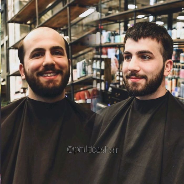 Before-After-Hair-Replacement-Phildoeshair