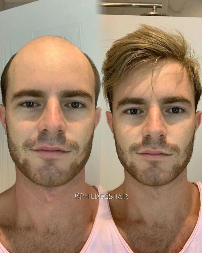 Before-After-Hair-Replacement-Phildoeshair