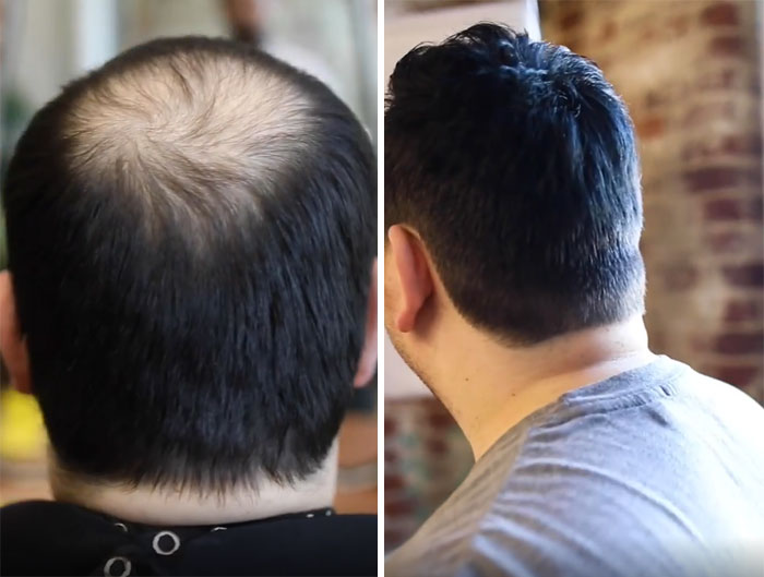Before-After-Hair-Replacement-Phildoeshair