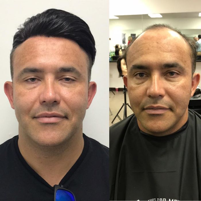 Before-After-Hair-Replacement-Phildoeshair
