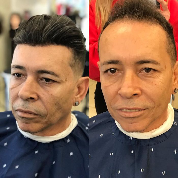 Before-After-Hair-Replacement-Phildoeshair