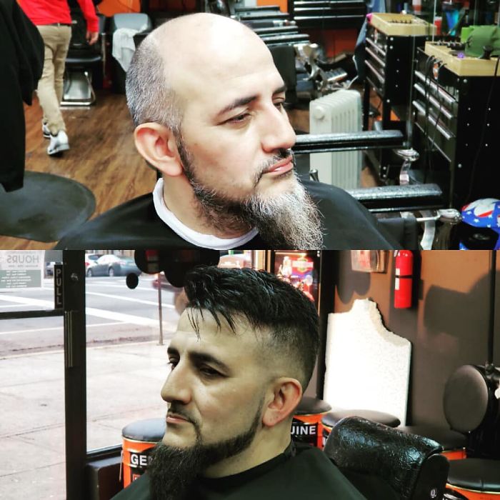 Before-After-Hair-Replacement-Phildoeshair