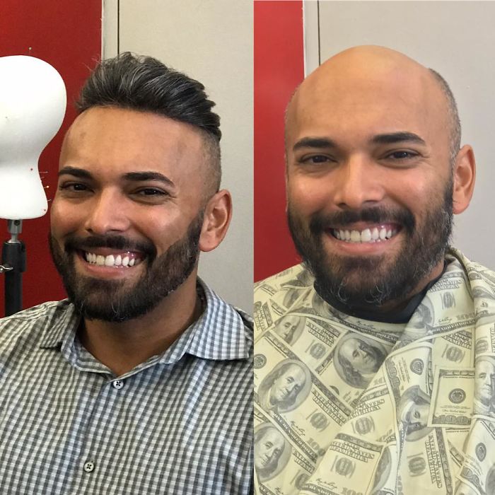 Before-After-Hair-Replacement-Phildoeshair