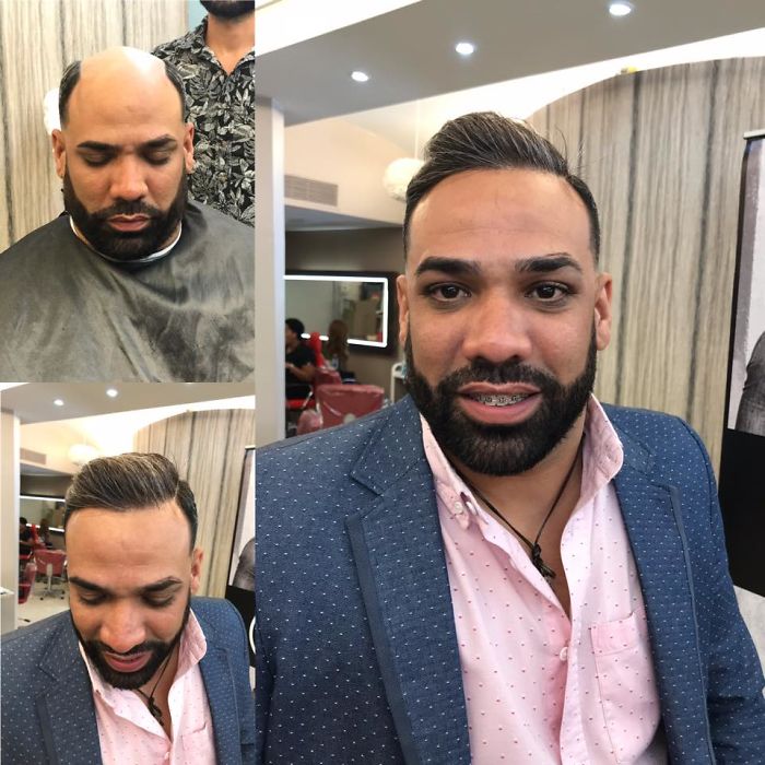 Before-After-Hair-Replacement-Phildoeshair