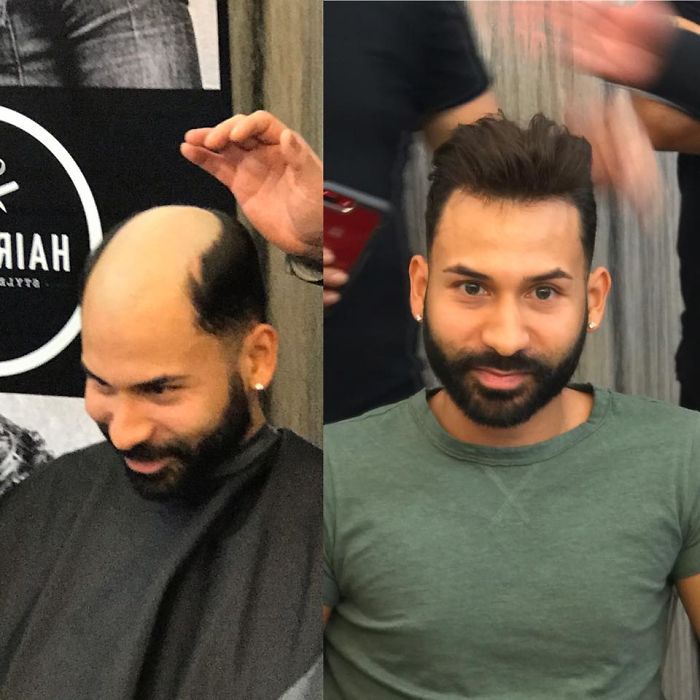 Before-After-Hair-Replacement-Phildoeshair