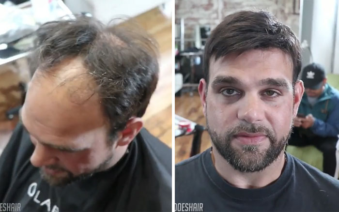 Before-After-Hair-Replacement-Phildoeshair
