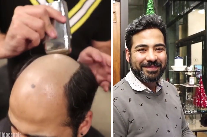 Before-After-Hair-Replacement-Phildoeshair