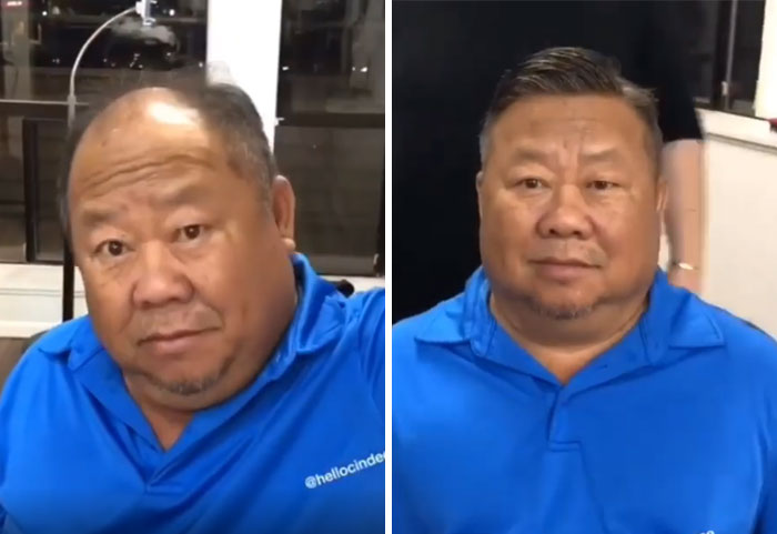 Before-After-Hair-Replacement-Phildoeshair